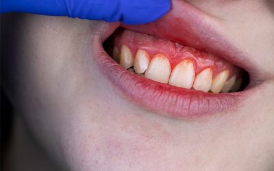Me sangran las encías al lavar los dientes