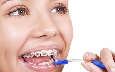 Cuidado de los dientes con brackets