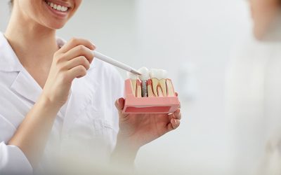 ¿Necesitas implantes dentales en Sevilla?