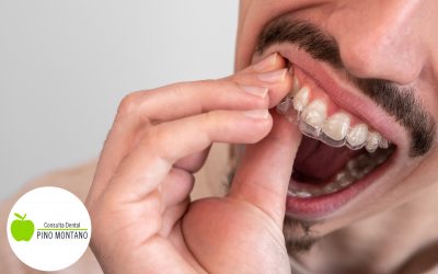¿Cómo cuidar los retenedores dentales?