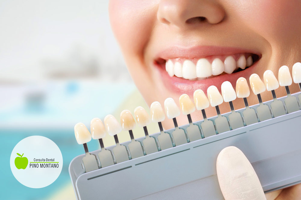 Blanqueamiento dental. Tratamientos y cuidados
