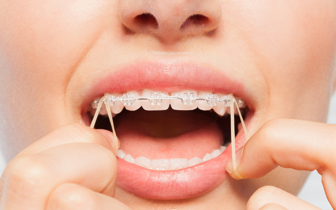 para-que-sirven-gomas-brackets