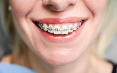 Alimentos que debes evitar comer con brackets