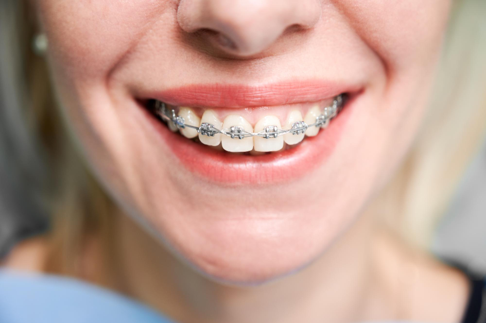 comer-con-brackets